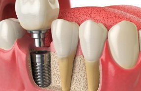 implantes