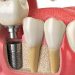 implantes