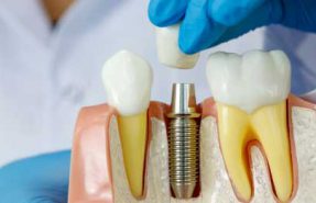 implantes-dentales-2