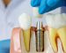 implantes-dentales-2