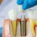 implantes-dentales-2